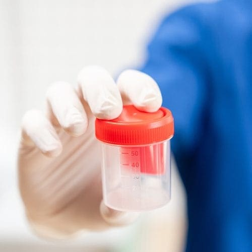 Mengenal Teratozoospermia atau Kelainan pada Sperma