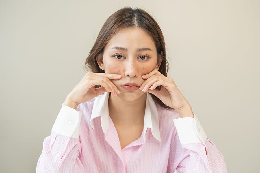 Lupus Adalah: Gejala, Penyebab, dan Pengobatan