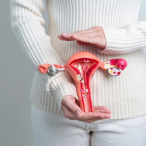 Mioma Geburt, Gangguan Reproduksi Wanita yang Menyebabkan Anemia
