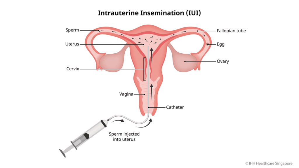 Apa Itu Inseminasi Buatan? Prosedur, Fungsi, Efek Samping