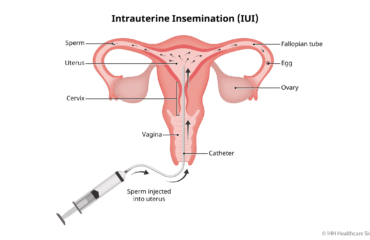 Apa Itu Inseminasi Buatan? Prosedur, Fungsi, Efek Samping