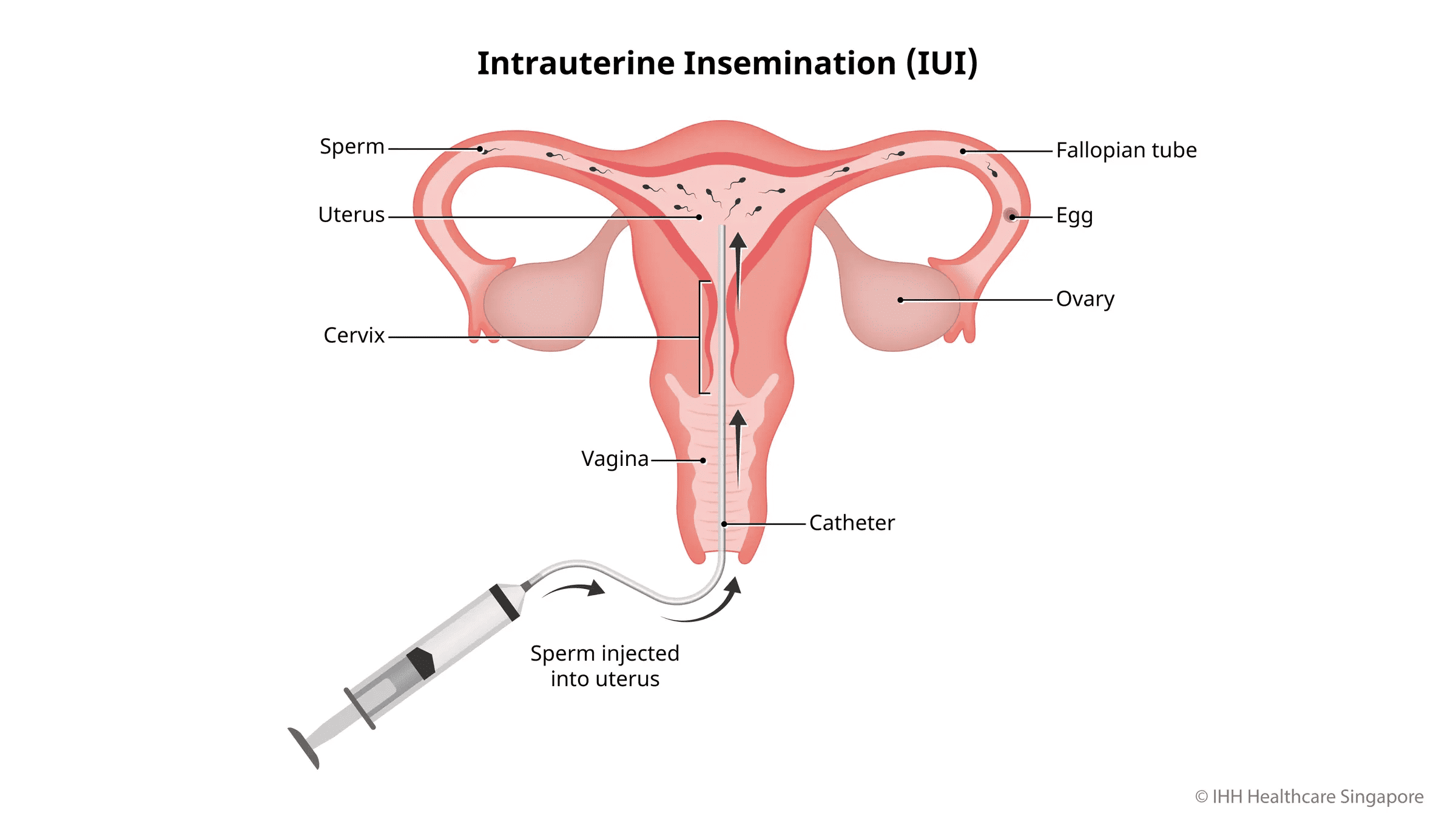 ilustrasi inseminasi buatan