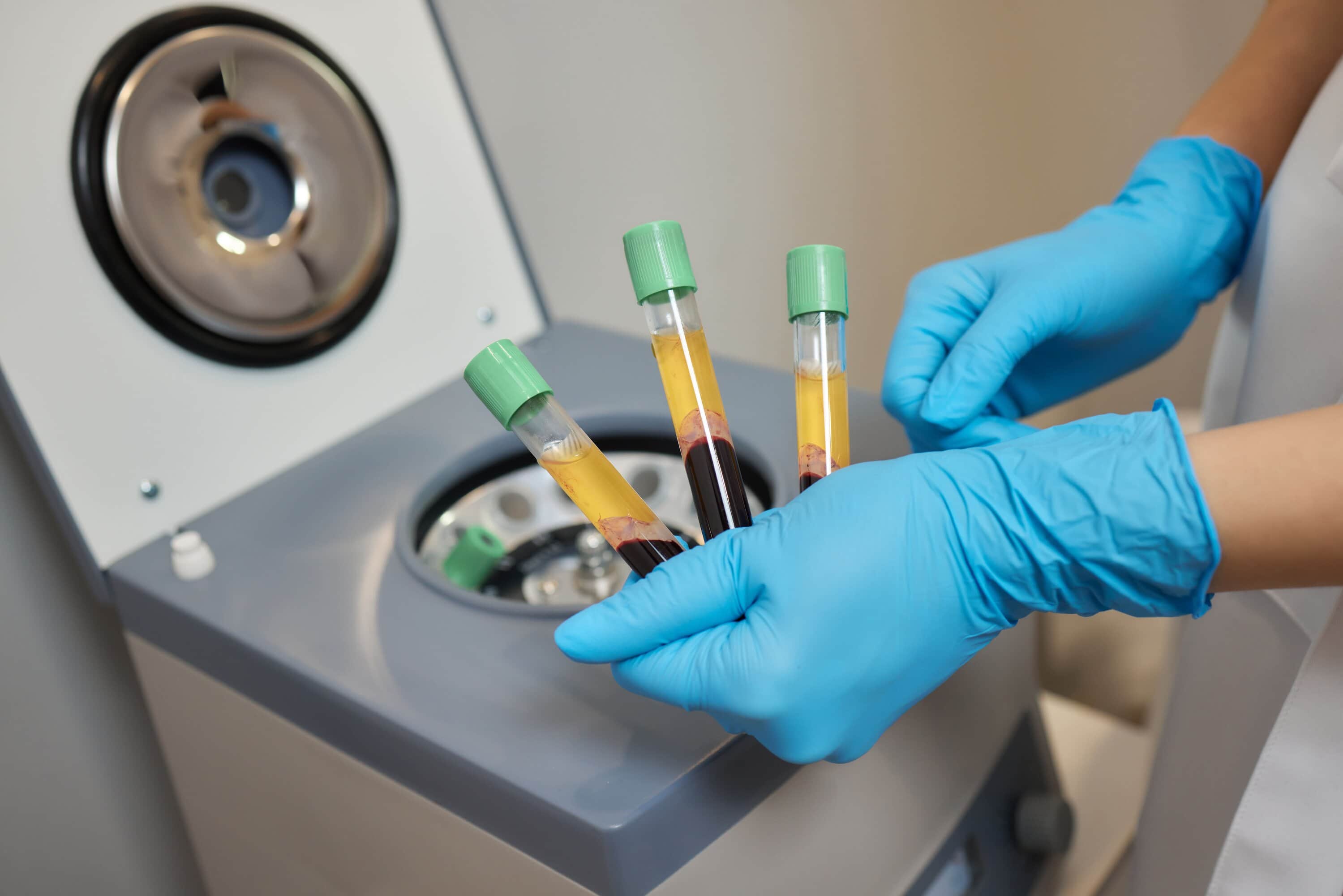 Perawatan PRP Ovarium di Ciputra IVF