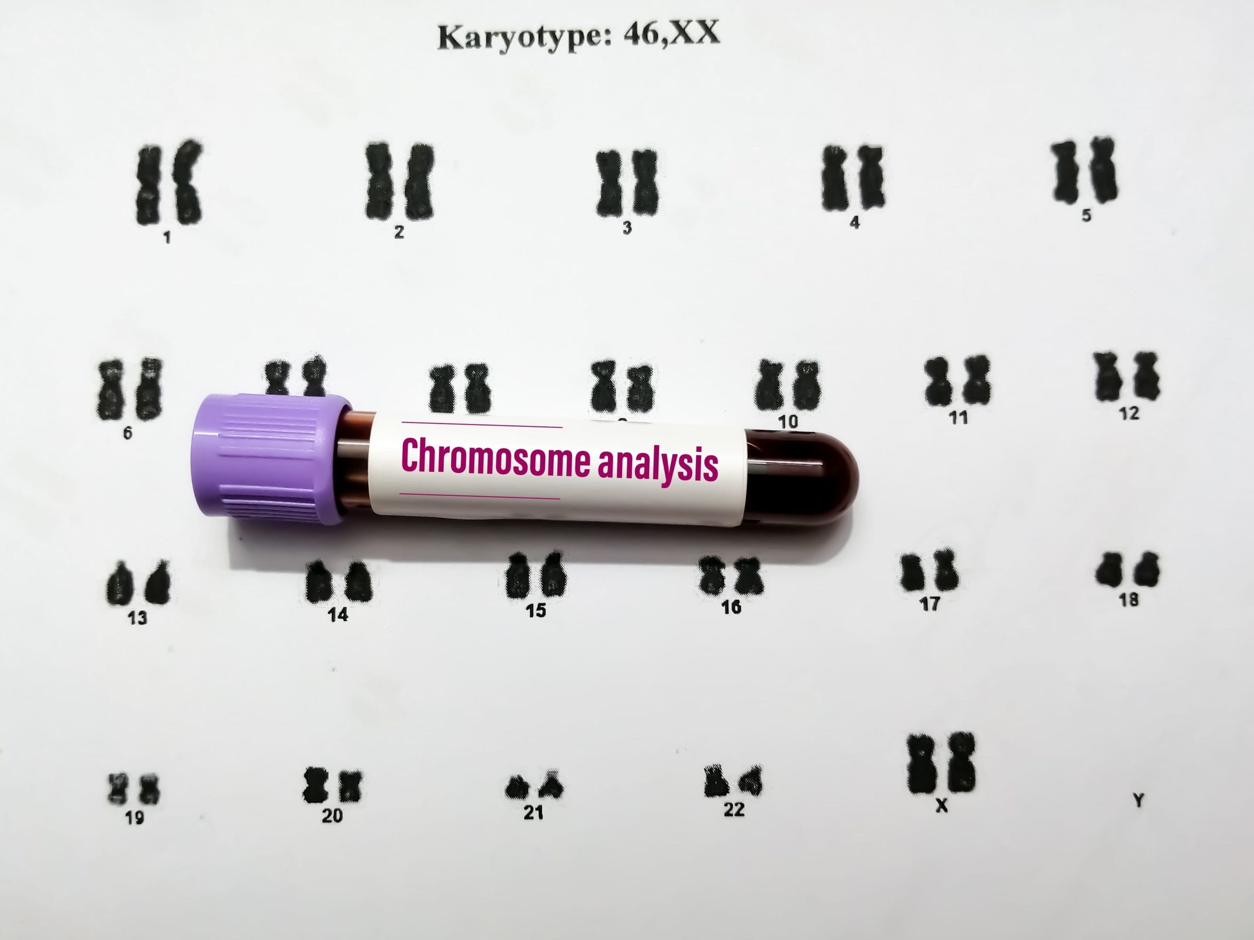 Mengenal Tes Karyotyping untuk Medekteksi Kelainan Genetik