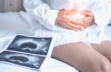 Jenis-Jenis Kista Ovarium: Dari Fungsional hingga Patologis