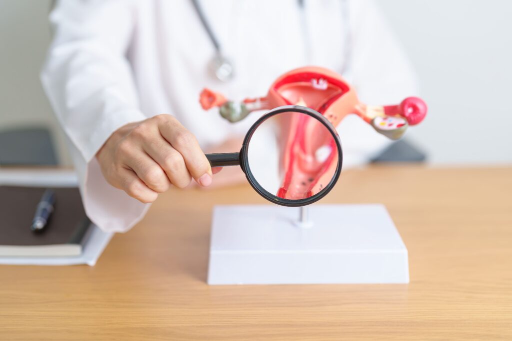 Kista vs PCOS vs Endometrioma: Perbedaan dan Cara Mengenalinya