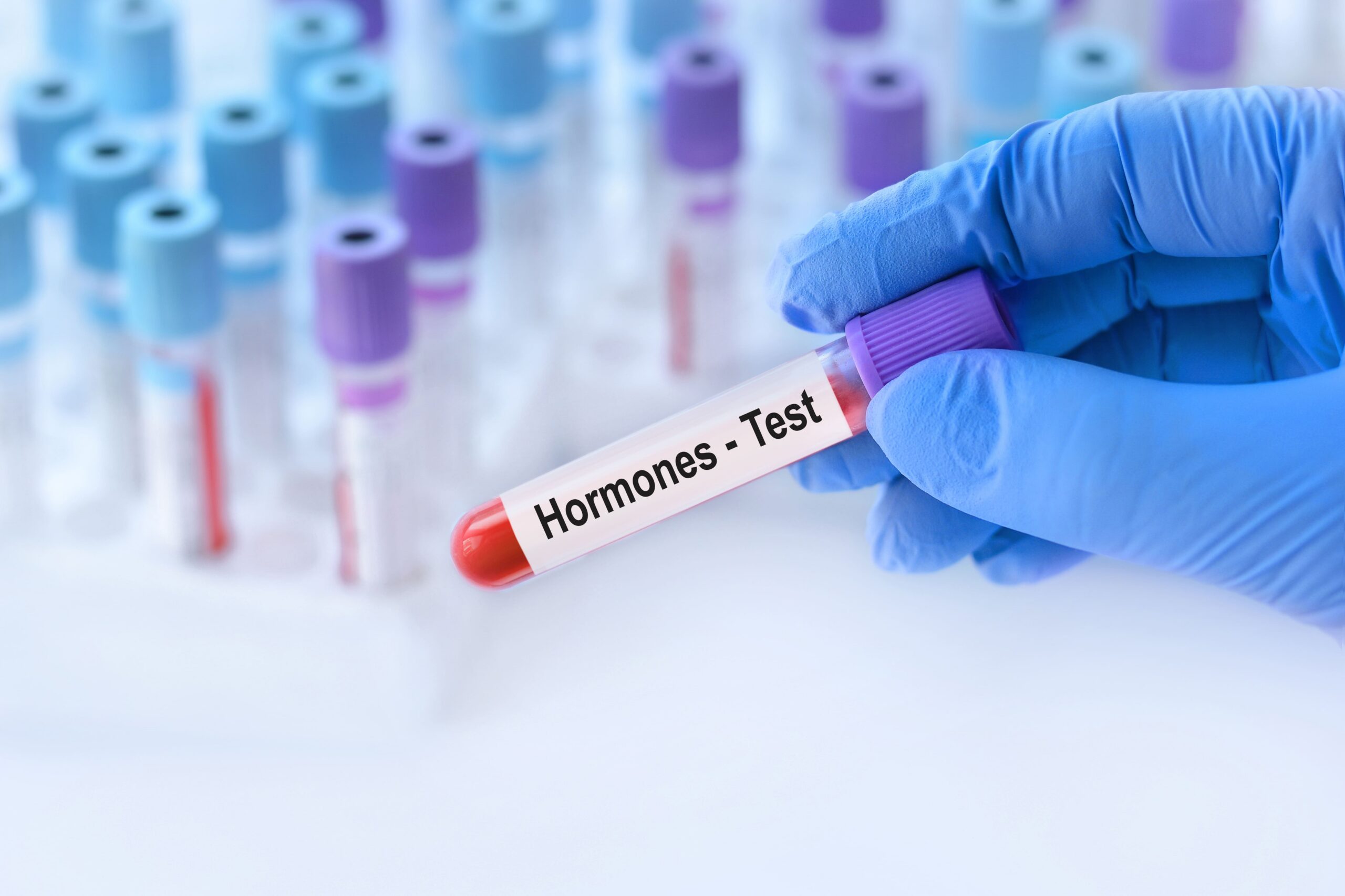 Cara Mendiagnosis PCOS: Tes USG, Hormon, dan Kriteria Rotterdam