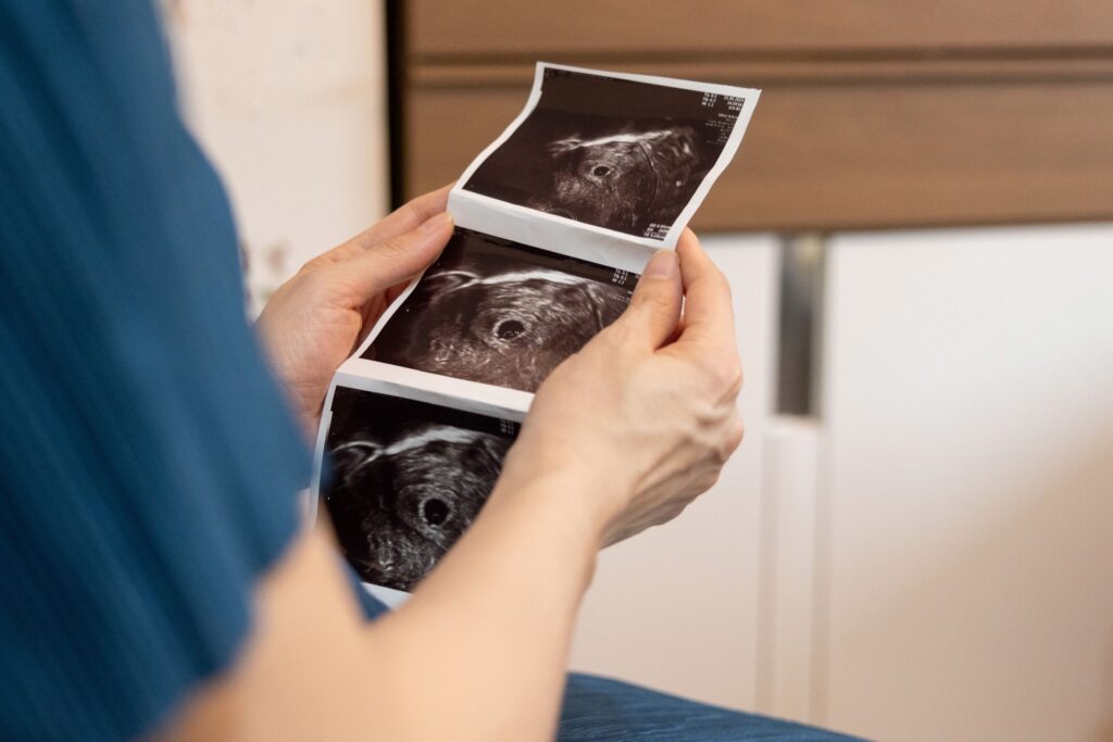 Apakah Bayi Tabung dan Pengobatan PCOS, Endometriosis, dan Kista Ditanggung BPJS?