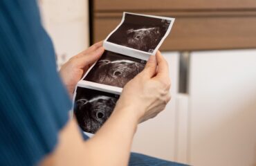 Apakah Bayi Tabung dan Pengobatan PCOS, Endometriosis, dan Kista Ditanggung BPJS?