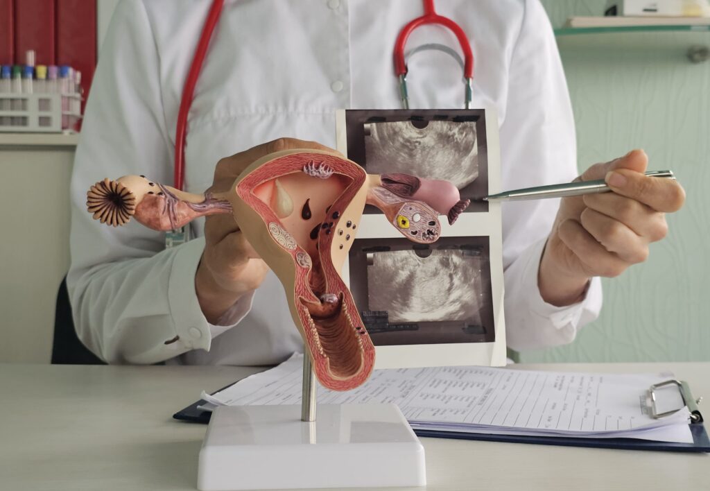 4 Stadium Endometriosis dan Penanganan Sesuai Tingkat Keparahannya