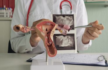 4 Stadium Endometriosis dan Penanganan Sesuai Tingkat Keparahannya