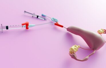 Inseminasi Buatan (IUI) untuk PCOS: Kapan Direkomendasikan?