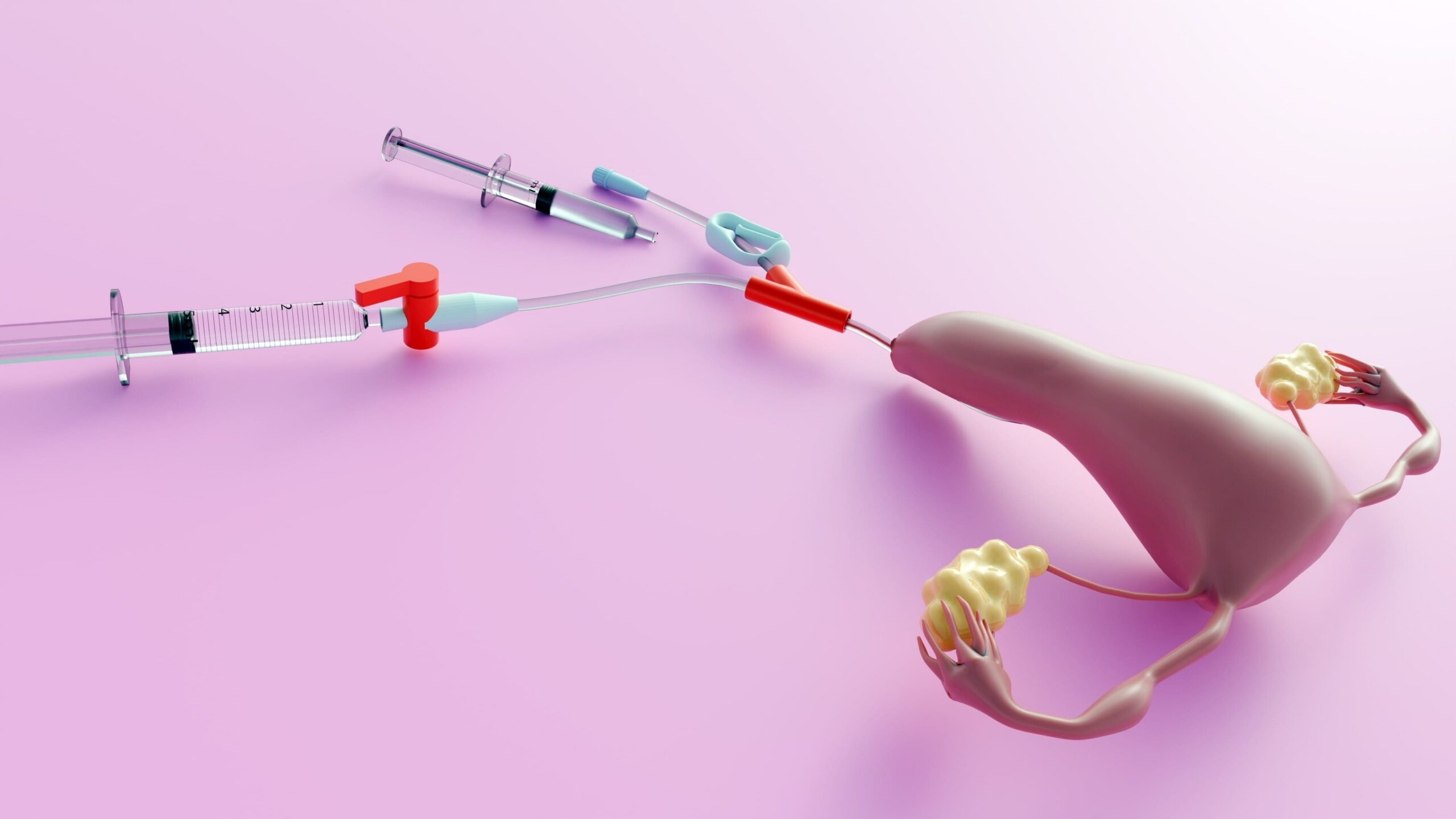 inseminasi buatan untuk pcos