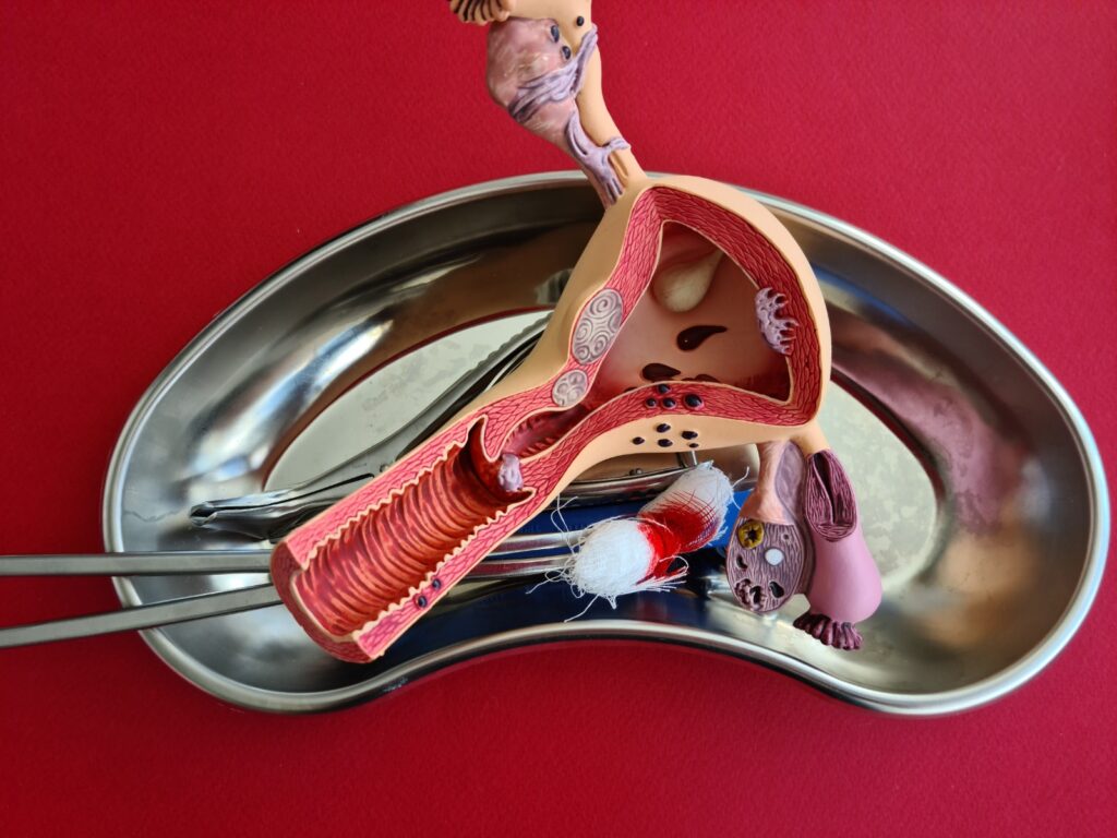 Operasi Endometriosis: Kapan Diperlukan dan Bagaimana Prosedurnya?
