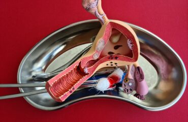 Operasi Endometriosis: Kapan Diperlukan dan Bagaimana Prosedurnya?