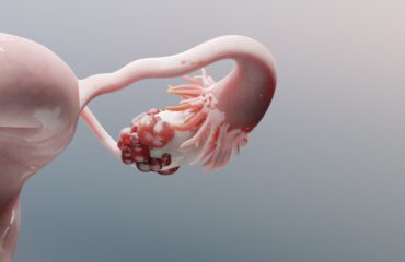 Kista Coklat (Endometrioma): Penyebab, Gejala, dan Pengobatan