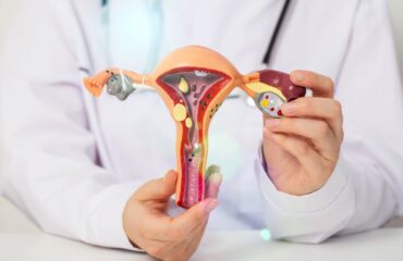 Penyebab Kista Ovarium: Mengapa Bisa Terjadi