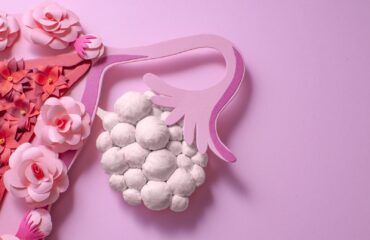 PCOS dan Risiko Keguguran