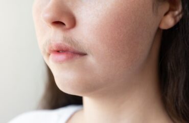 Hirsutisme dan PCOS: Mengapa Bulu Tubuh Tumbuh Berlebih