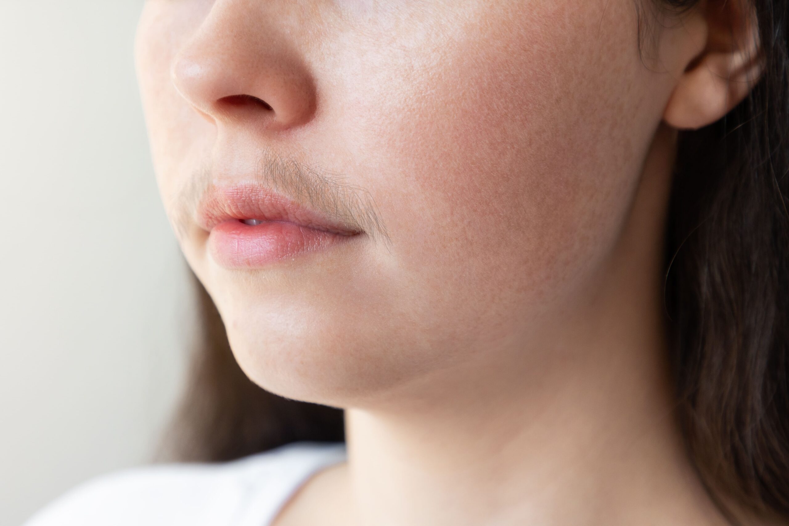 Hirsutisme dan PCOS: Mengapa Bulu Tubuh Tumbuh Berlebih